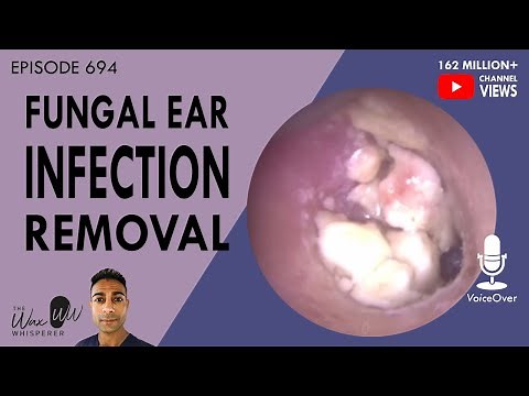 694 - Fungal Ear Infection Removal