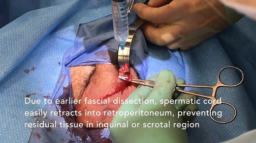 Simple orchiectomy for transgender patients