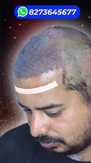 My Hair Transplant Cost Of 4000 Grafts 🔥🔥🔥 #hairtransplantcost