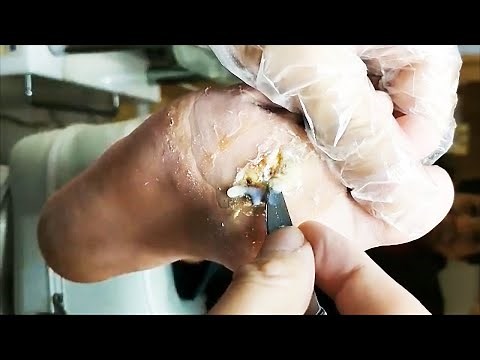 Infected foot wound with pus, plantar wart removal-Satisfying & Relaxing Video#09