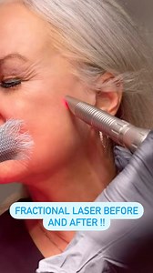 47K views · 18 comments | AMAZING RESULTS 朗 Tighten your skin with a Fractional Laser Treatment! Try your first session for ONLY $299! ($1000 Value) Hurry today only. Call or text Cell. (904) 916-1041 to purchase! #Fotona#Pvfl#Florida#Pontevedrabeach#MedSpa#Jacksonville#Skincare#Skincaregoals#Skin#Nofilter#Nearme#Beautiful#Aesthetic#Explorepage#Fyp#Laser#Jaxbeaches#Skinbetter#Altodefense | Laser Loft | Facebook