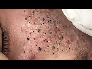 Super Satisfying blackheads removal video