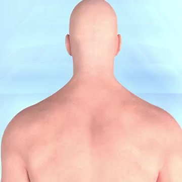 Craniectomy Brain surgery operation Doctor of physical therapy | Doctor of physical therapy