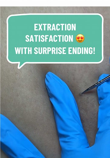 Satisfying Ingrown Hair Extraction Video Compilation