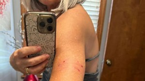 Rabid fox attacks woman relaxing in backyard