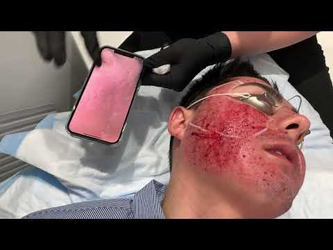 IMPROVE CHEEK ACNE SCARS WITH DEEP HALO AND PROFRACTIONAL LASER |West Hollywood, CA | Dr. Jason Emer