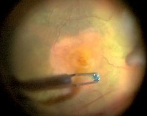 Repair strategies for refractory macular holes