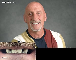 Dental Implants