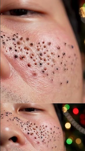 This Christmas Pimple Was READY to Pop 🎄😳