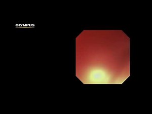 Dr. Loren Clinical Video featuring TJF-Q190V