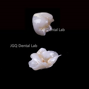 [Hot Item] Natural-Looking Restorations Zirconia Restorations IPS Emax Veneer Onlay Inlay Dental Lab Price