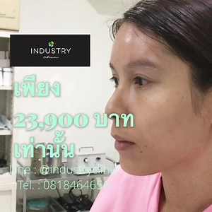  เสริมหน้าผากที่ industrt clinic หลังทำทันที  ⚡️ สวยเป๊ะ...