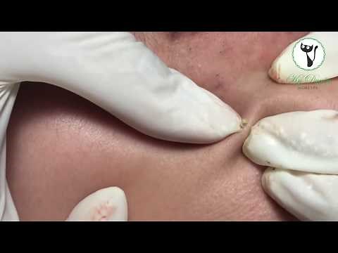 Xử lý vật thể lạ trên vành môi to đùng | Gà Spa