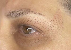 Fibroblast Skin Tightening — Take it Off PDX