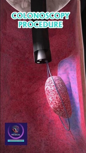 How to Performed Colonoscopy | Endoscopy Procedure |