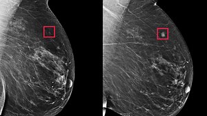 This MIT AI Predicts Breast Cancer Risk Up to 5 Years in Advance