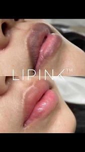 If you've ever thought about getting lip embroidery to cover up the darkening of the lip area...this is for you! Say goodbye to painful treatments that leave you with two weeks of swelling and downtime. If your goal with lip embroidery is to cover up dark or uneven lip discoloration, there's a better solution. Introducing the new ONLYPink—restore your lips to their natural shade in just one session! #lipink #onlypink #lipcare #onlyaestheticssg #NoMoreDarkLips #onlyaestheticssg | ONLY Aesthetics