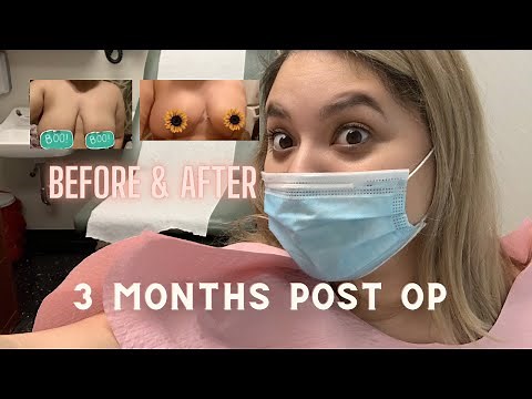 Breast Reduction Surgery 3 Months Post Op (before and after)