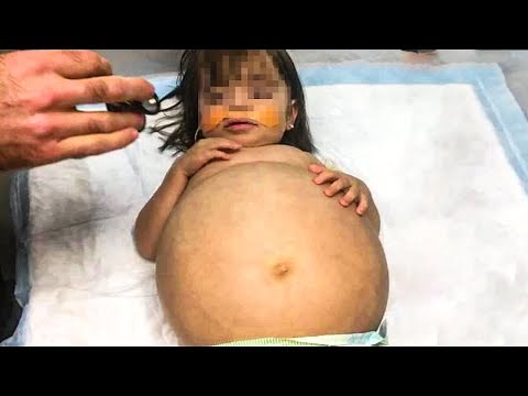 This Baby's Belly Kept Growing Nonstop, Then The Doctors Delivered The Alarming News To Her Parents