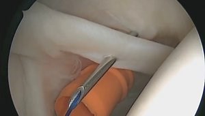 Arthroscopic Proximal Biceps Tenodesis Using a Knotless Suture Anchor