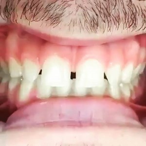 Instant Teeth Gap Closure | Dr.Sreenath S
