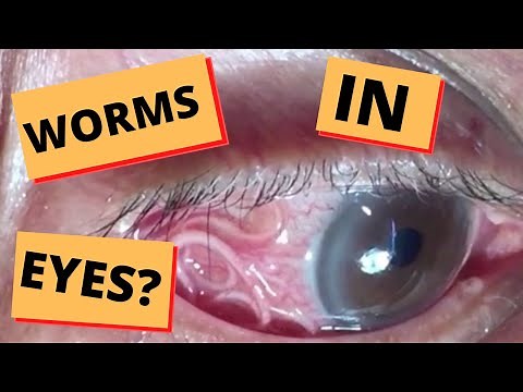 How Does a Person Get Worms In Their Eyes?