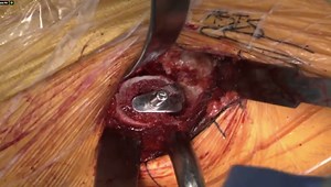Direct Anterior Approach Utilizing a Modern Triple-taper Femoral Stem: Femoral Preparation and Joint Tensioning (Part 3 of 4)