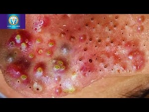 Is This Technique SAFE? Professional Drainage for PAINFUL, Inflamed Cystic Acne Revealed