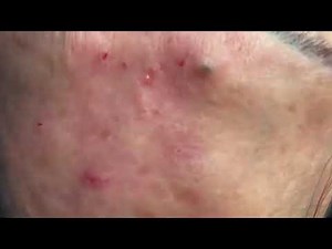 Steatocystomas - squeeze acne