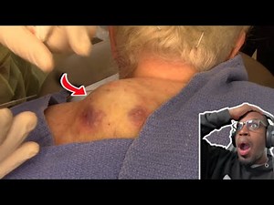 I DID NOT KNOW THEY GREW CYST IN IDAHO! | Idaho Potato Cyst - Dr. Derm