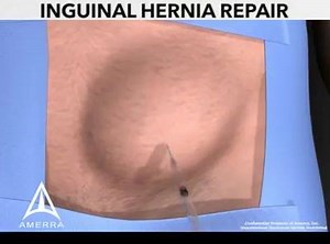 53K views · 332 reactions | Inguinal Hernia Surgery 3D Medical Animation | Medical Video | Facebook