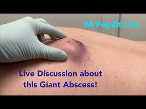 Giant ruptured cyst abscess Discussion. Come listen and bring your questions.