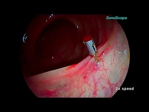 Advanced Colonoscopy with HD-550 & VIST/SFI Chromoendoscopy | SONOSCAPE Technology by TPMS