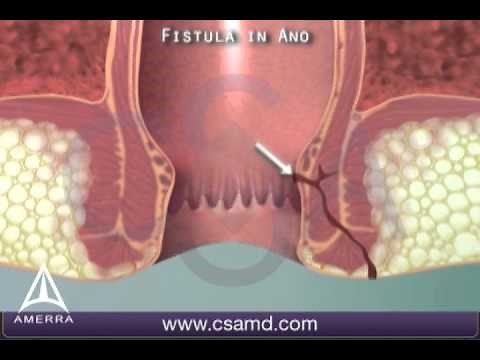 What is a fistula in ano? 3D animation