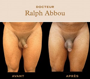 Penoplastie Paris : agrandir et élargir le pénis