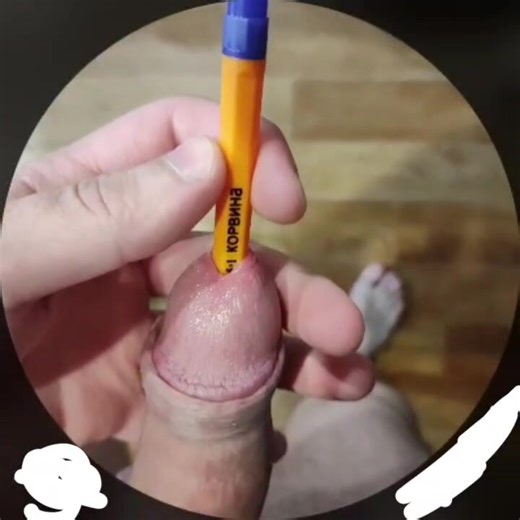 Urethral dilation of the vile penis