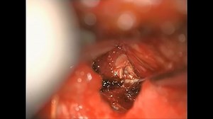 Lumbar Hemilaminectomy   Discectomy