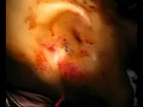 Flail Chest with Paradoxical Motion | NEJM