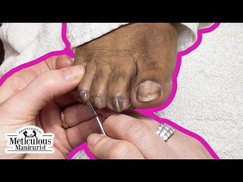 Twisting, Turning, and Curling Toenails Pedicure Tutorial