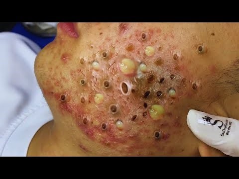 Massive Blackhead Extraction | So Satisfying ✨ | Acne Scars Treatment