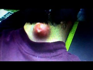 Biggest Zit In The World