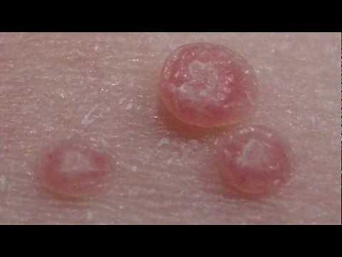 How to treat Molluscum Contagiosum