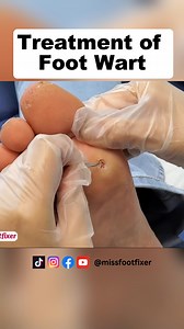 Follow Up video [ Wart Removal ] | Miss Foot Fixer #missfootfixer #footwartremoval #wartremovaltreatment | Miss Foot Fixer