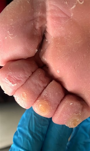 Satisfying callus removal from feet & Foot scraping dead skin #pedicure | Nail Salon