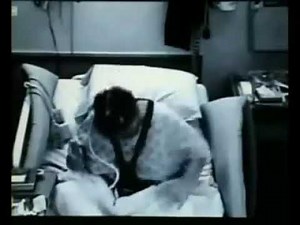 alien hand syndrome || corticobasilar degeneration|| stroke|| read description