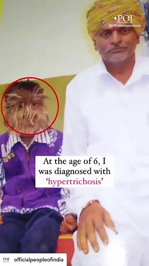 @officialpeopleofindia “I am one-in-a-million and I will never give up” ✨Narrated to POI by: @lalitpatidar520 #trendingreels #reelitfeelit #reelkarofeelkaro #explorepage #explore #fighter #emotional #journey #inspirational #motivation #motivational #positivevibes #dailymotivation #positivity #positivevibesonly #werewolf#syndrome #rarecondition | Beauty Full | Facebook