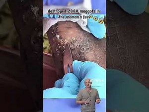 satisfying videos jiggers removal and cleaning jiggers digging