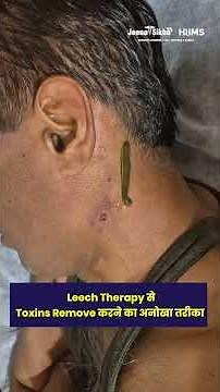 लीच थेरेपी (Leech Therapy) for Varicose Veins, Skin, Joint & Hair Fall Problems | HiiMS Hospital