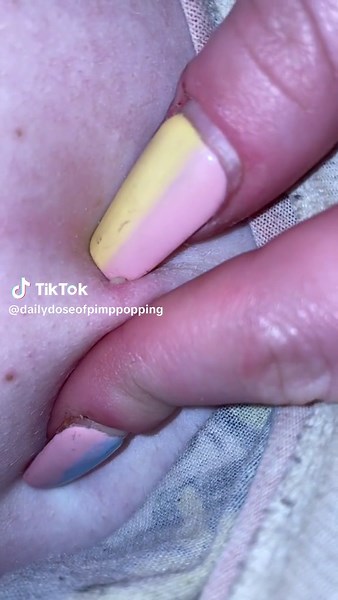 Leg Pimple Extraction: Satisfying Pop for Clear Skin