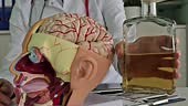 Anatomical model of the brain with alcohol in the hands of a doctor....